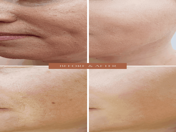 ORGANIC HYALURONIC WRINKLE DEFIER -  For Women and Men-1
